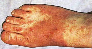 医生提醒:因为湿疹的症状和脚癣相同,很多人把湿疹当成脚癣,用