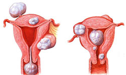 子宫肌瘤的早期信号！