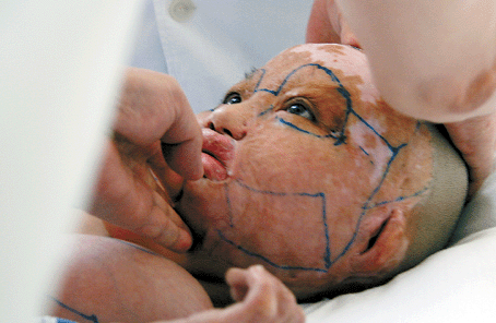 小琳秀被推进手术室,据艾玉峰介绍,手术的难度在于,既要保证皮瓣移植