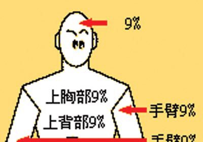 趣智博文:烧伤面积是怎么算出来的?(组图)