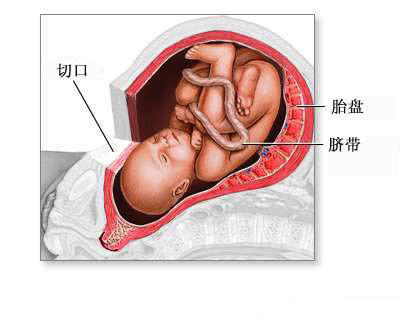 剖腹产手术彩色图例解说