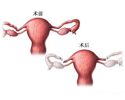 女性输卵管结扎术图解