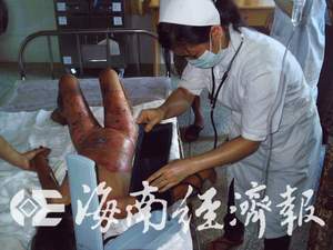 3天收治4名重烧伤患者 专家:市民要改变生活习惯(图)