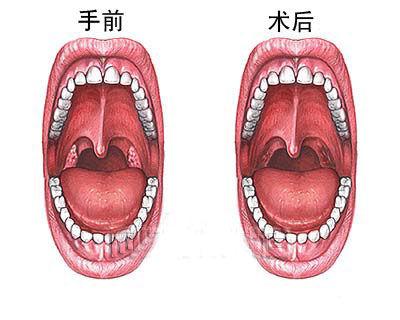 割扁桃体影响买保险么 扁桃体手术商业险给报销吗