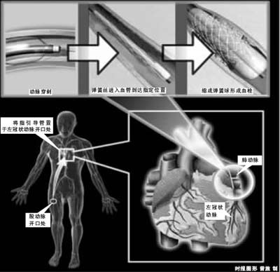 老翁心脏天生多一条血管 大腿打洞送入弹簧堵