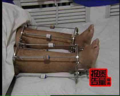 与期待的恰恰相反,不但没有实现断骨增高,反而因为手术失败而造成骨