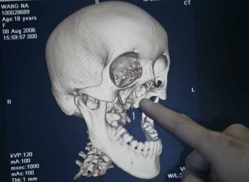 凹面少女二期手术宣告成功 重建上颌骨(图)