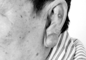 73岁老太具有斑痕体质 激光穿耳洞耳垂频长瘤