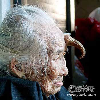 95岁老人前额长出约12厘米长犄角(图)