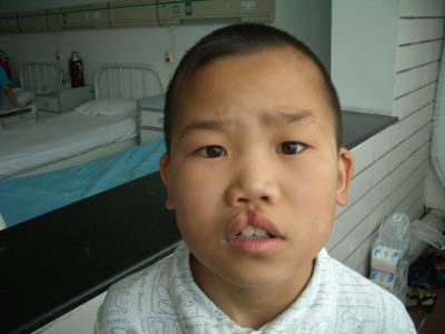 "微笑列车"在北京实施 救助贫困唇腭裂患者