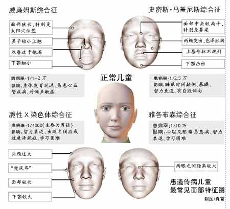 英专家研发电脑软件 看儿童面相诊断遗传病(图)