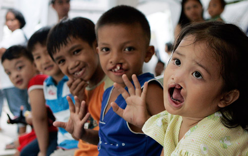 菲律宾:微笑行动关爱唇裂儿童(组图)