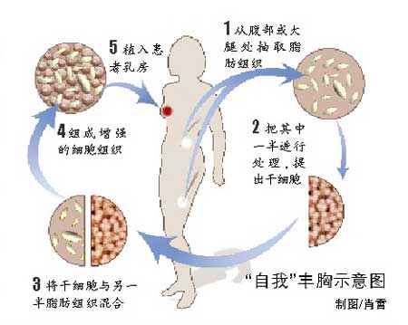 日本发明干细胞自我丰胸 不再用人工填充物(图