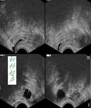 排卵期的超声表现 图 搜狐母婴