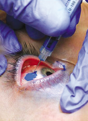 加拿大男子在眼球上文身 刺40针变蓝眼睛(组图