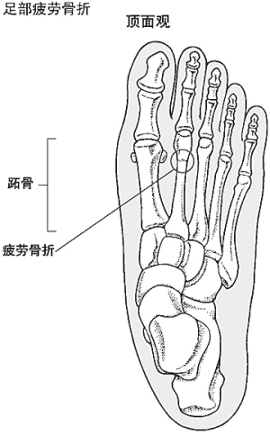 疲劳性骨折最常见的发生部位——第二跖骨