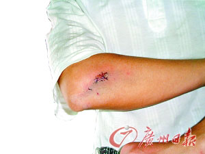 网友"玉树临风"身体多处被打伤,手臂淤血红肿.