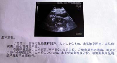 大龄产妇误诊宫外孕引产(图)
