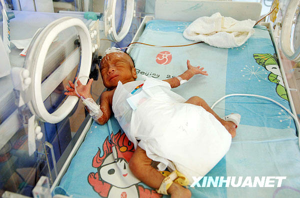 重庆最小早产儿满月 出生不足一公斤(组图)
