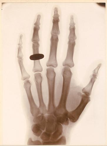 5,戒指手的x射线照片(1896年)