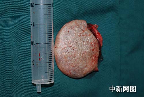重庆初生男婴脑后长鸭蛋大血管瘤 手术切除(图