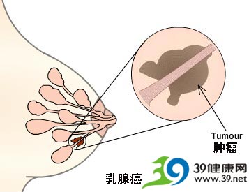 解密乳房的疾病