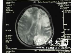 女童曾患脑膜炎 致脑袋里仅有常人一半脑髓(图)