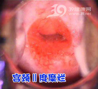 肉眼或阴道镜下见到颗粒状的红色区,称宫颈糜烂