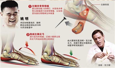 姚明手术成功:骨头裂缝已嫁接 左脚足弓被削平