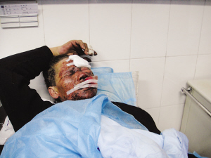 南京一男子被烟花炸伤脸