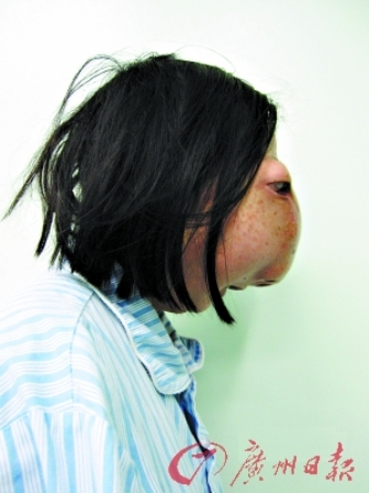 由于患有颅脑颌面肿瘤,22岁的吴小燕面部严重畸形,侧脸有点像"