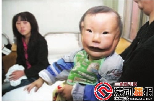 湖南女子生下面具男婴 3次B超显示发育正常