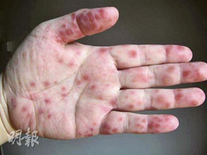 香港一女护士染肠病毒亡 双手出疹照常上班(图