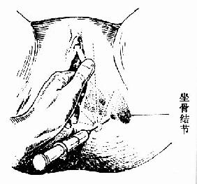 在坐骨棘内侧下方注入麻醉药
