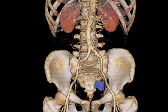 在这张图中，PET扫描确认的癌组织是蔚蓝色圆团状物体，而CT扫描锁定了它在结肠的位置。
