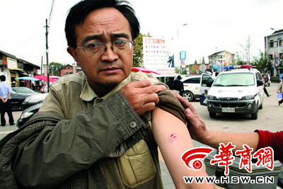 刘勇的左臂被狗咬伤,衣服也被咬破 本报记者 何杰 摄