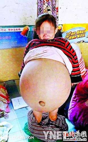女童患怪病肚子大过孕妇 网友助其来京治疗(图