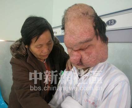 中国最恐怖的怪病:狮面人鱼鳞人狼人等(组图)