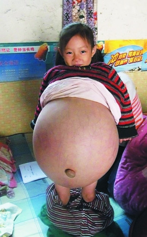 4岁女童肚子大过孕妇追踪:基金会搭捐款平台(图)