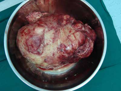 胸腔重达3000克巨大肿瘤 三次开胸手术终摘除