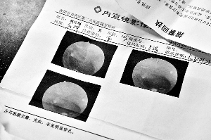 检验报告显示小伟左耳鼓膜充血但未穿孔.