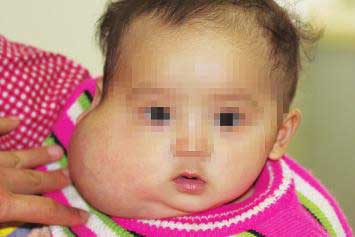 五月大女婴右脸比左脸大两倍术后恢复