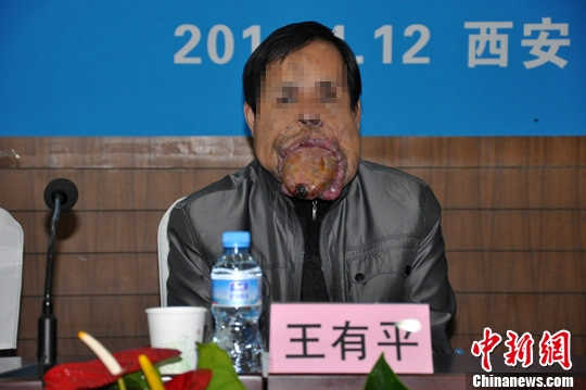 西安收治罕见"巨舌症"患者 舌体突出口腔外