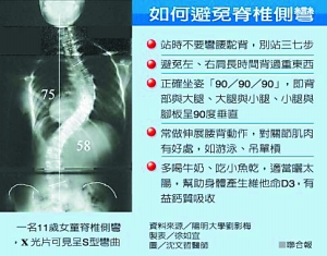 脊柱弯曲 不会"长大就变好"(组图)