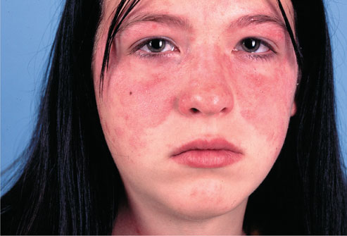 皮肤上的疾病信号(组图)