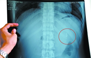 胃部x光片清晰显示鱼钩的存在.记者邵权达摄