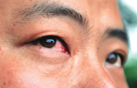 崇州28个孩子眼红发烧住院