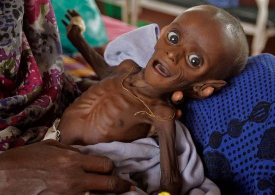 据联合国官网称,这次干旱造成多达1150万人受灾,其中儿童的营养不良率
