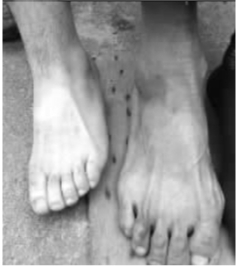 李方平的大脚(右)与一个正常成年男子42码的脚对比.