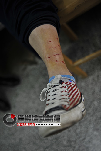 (12月19日,长沙市疾控中心,被狗咬伤的学生做伤口处理.